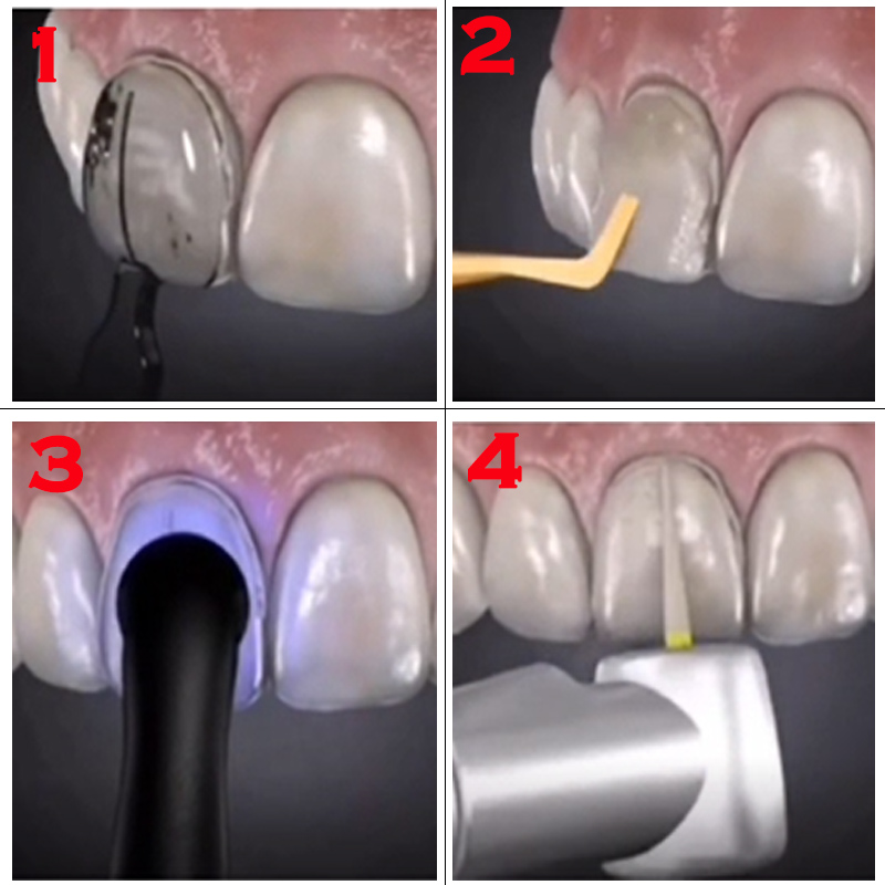 Autoclavable Dental Veneer Mou - Teeth Whitening Moulds 评论和价格
